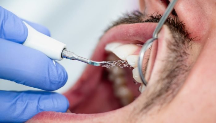 Plaque remover close-up