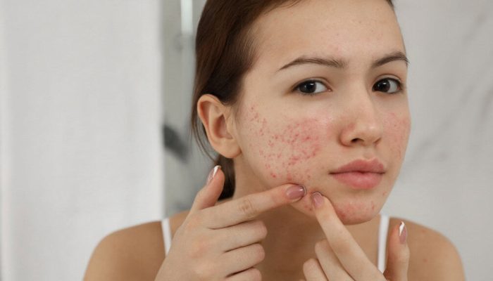 acne-expremer-1-1-1024x576-1